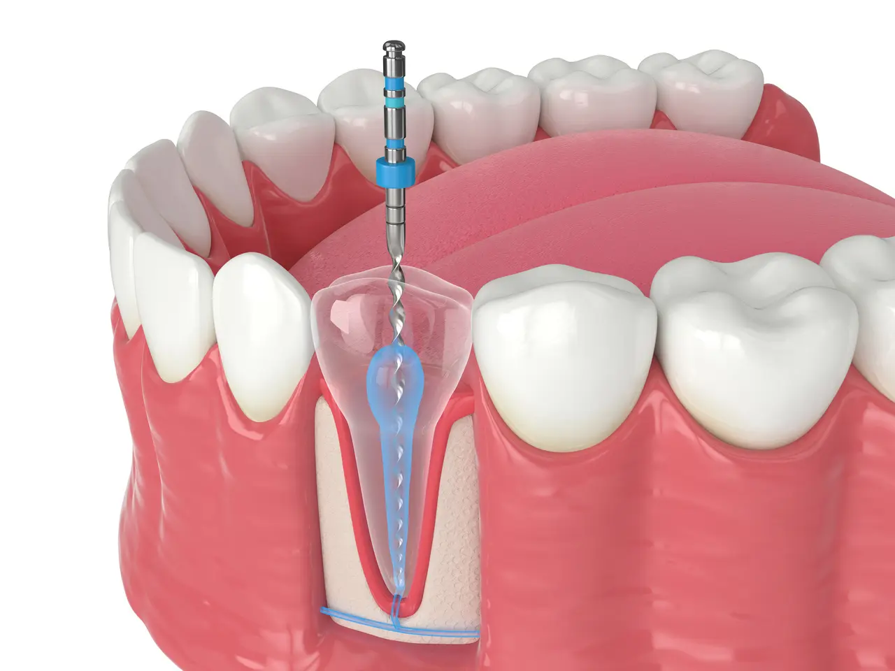 Comparing endodontic treatment and diagnostic services at Molina Endodontics